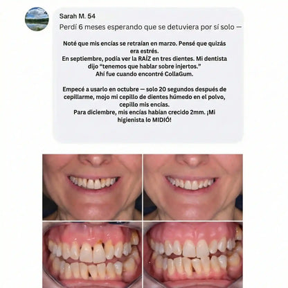 El "Restaurador de Encías" Más Potente Del Mercado – Collagum™